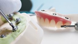How Do You Determine If You’re a Good Candidate for All-on-4 Implants? How Do You Determine If You’re a Good Candidate for All-on-4 Implants?