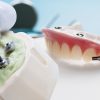 How Do You Determine If You’re a Good Candidate for All-on-4 Implants?