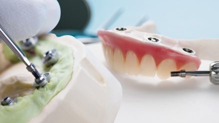 How Do You Determine If You’re a Good Candidate for All-on-4 Implants?